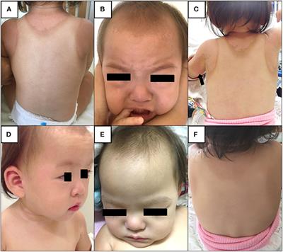 Kawasaki Disease Following Severe Sunburn Injury